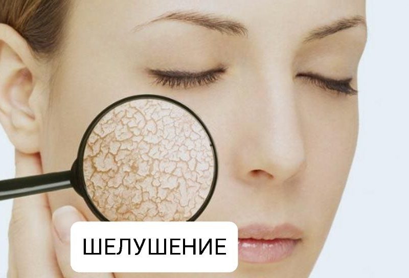 Причины шелушения кожи